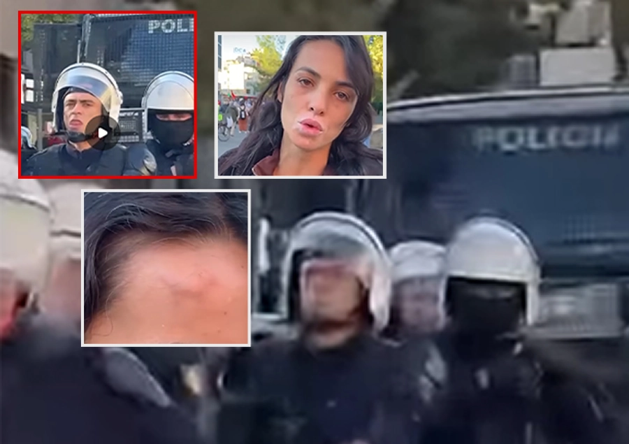 Studentja: Më goditën me shkop gome, ndërkohë që nuk po bëja asgjë